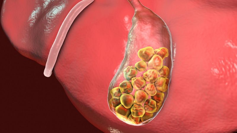 पित्ताशय की पथरी का जल्दी करें निवारण