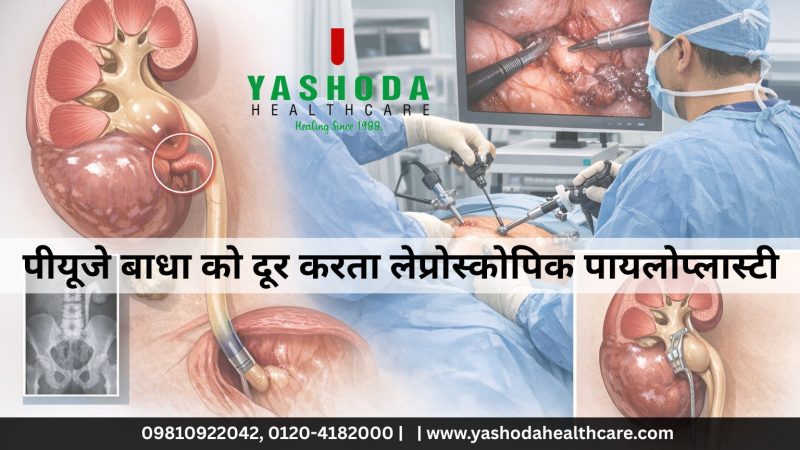 पीयूजे बाधा को दूर करता लेप्रोस्कोपिक पायलोप्लास्टी