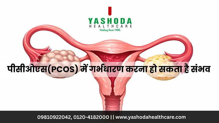 पीसीओएस(PCOS) में गर्भधारण करना हो सकता है संभव