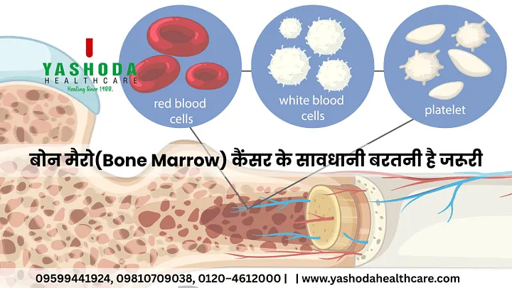 बोन मैरो(Bone Marrow) कैंसर के सावधानी बरतनी है जरूरी