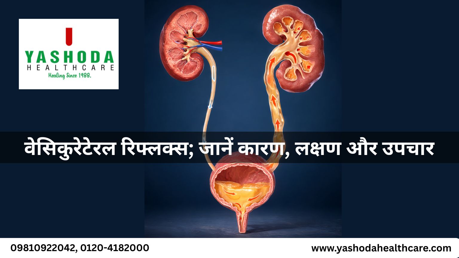 वेसिकुरेटेरल रिफ्लक्स(Vesicoureteral Reflux); जानें कारण, लक्षण और उपचार