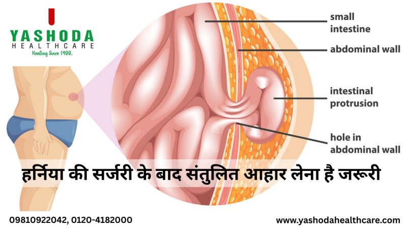 हर्निया की सर्जरी के बाद संतुलित आहार लेना है जरूरी