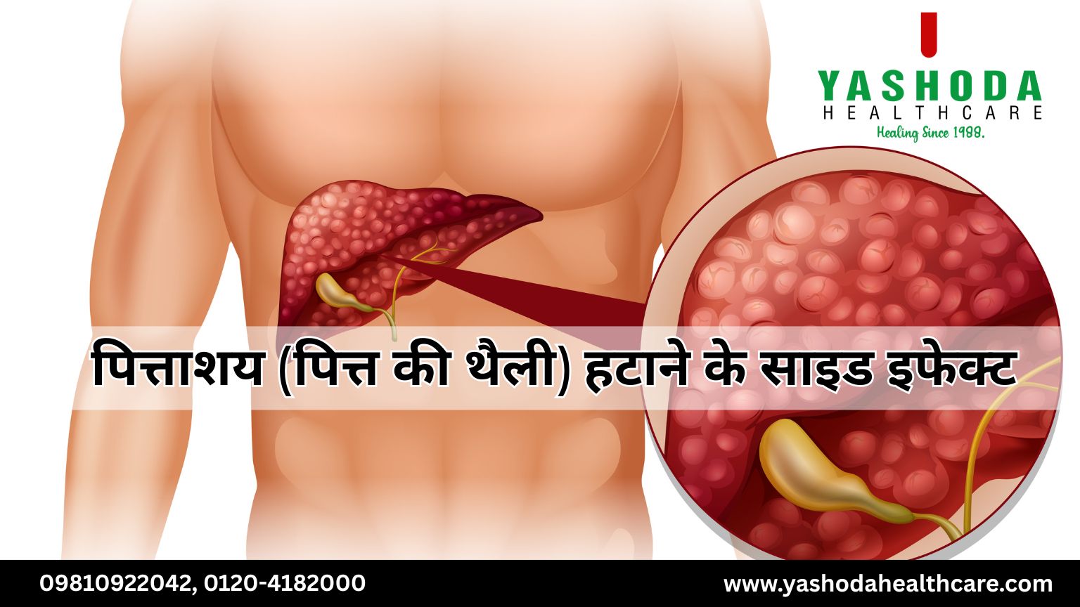 पित्ताशय (पित्त की थैली) हटाने के साइड इफेक्ट