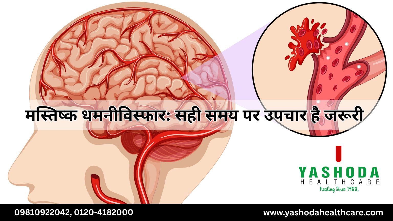 मस्तिष्क धमनीविस्फार: सही समय पर उपचार है जरूरी