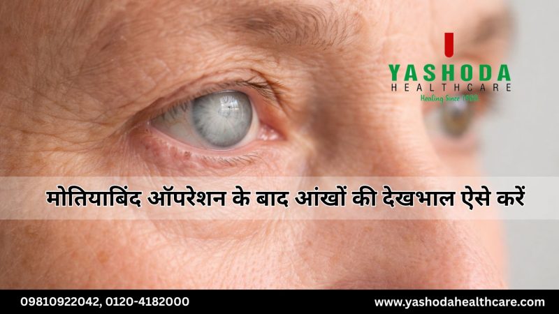मोतियाबिंद ऑपरेशन के बाद आंखों की देखभाल ऐसे करें