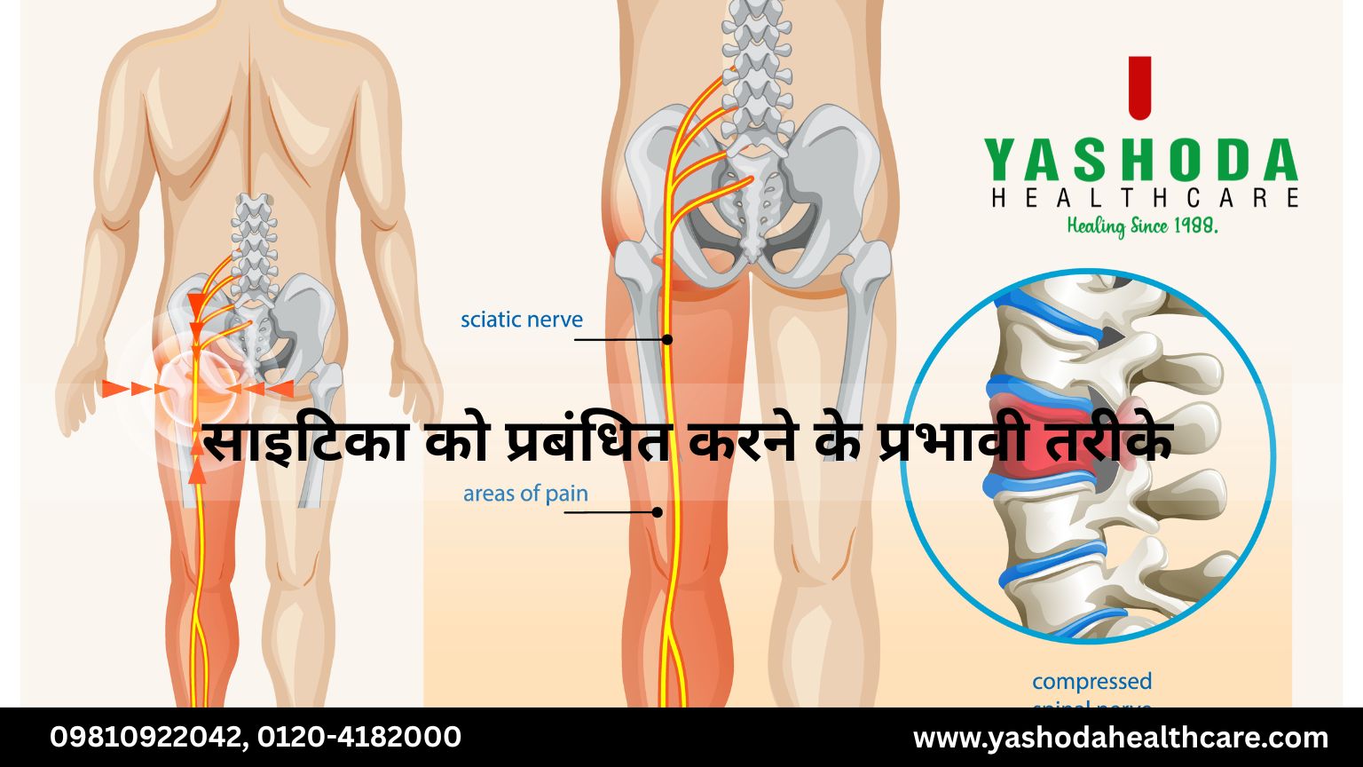 साइटिका को प्रबंधित करने के प्रभावी तरीके