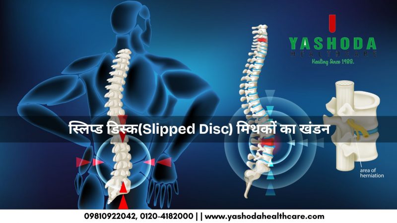 स्लिप्ड डिस्क(Slipped Disc) मिथकों का खंडन