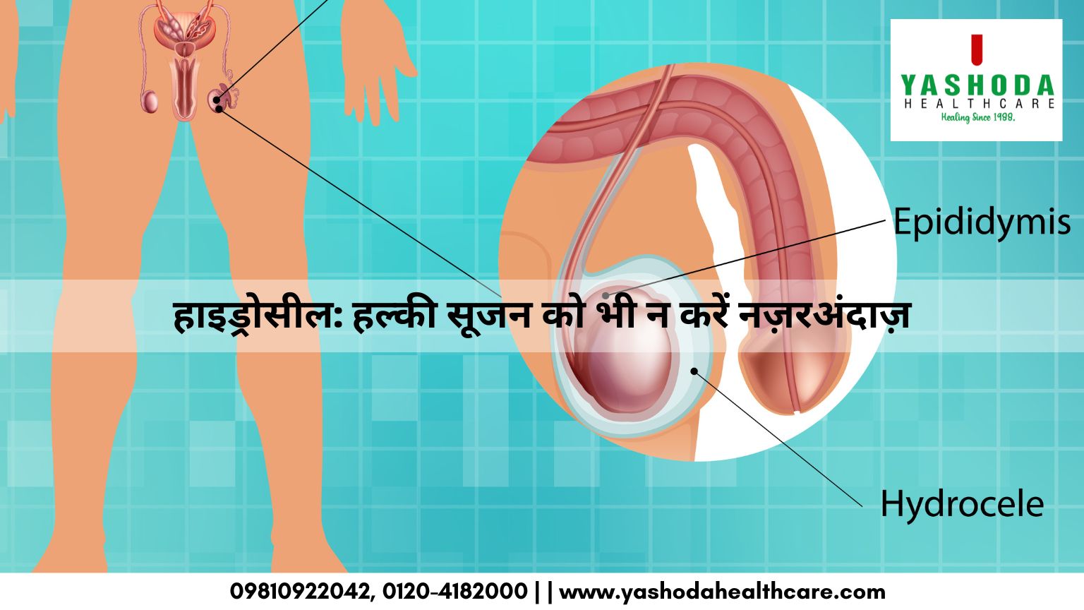 हाइड्रोसील(Hydrocele): हल्की सूजन को भी न करें नज़रअंदाज़