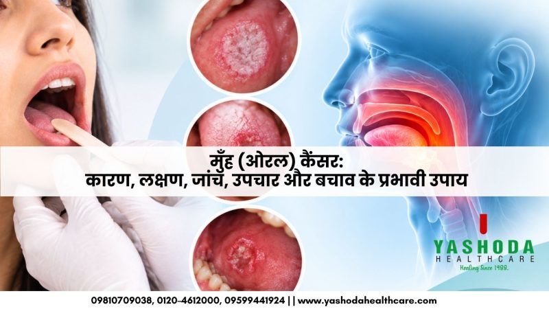 मुँह (ओरल) कैंसर