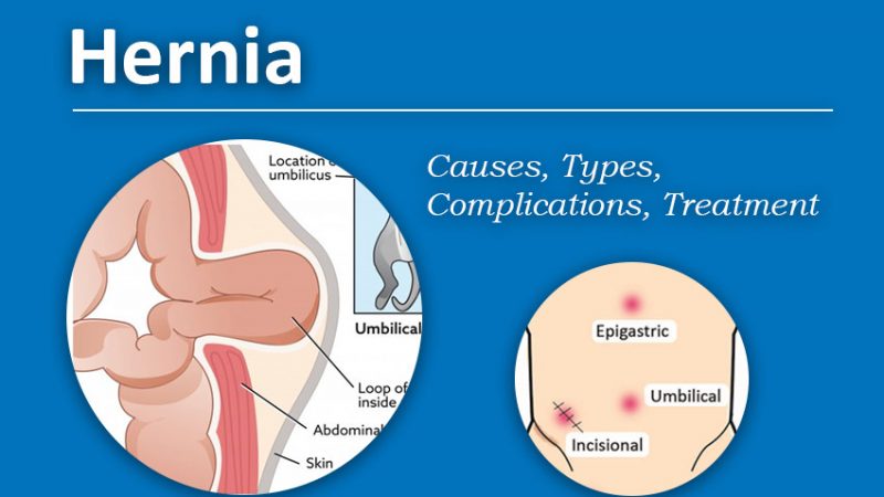 Hernia : Types, Causes & Symptoms