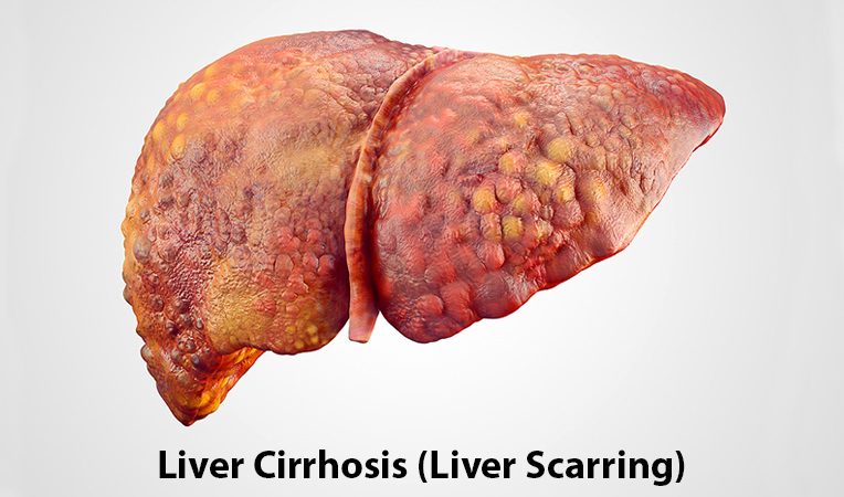 Best Hospitals For cirrhosis Treatment In Ghaziabad