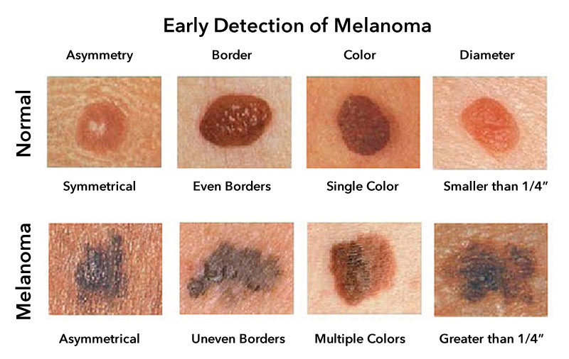 Melanoma Skin Cancer, Types, Stages, Grades, Signs, Symptoms, Risk
