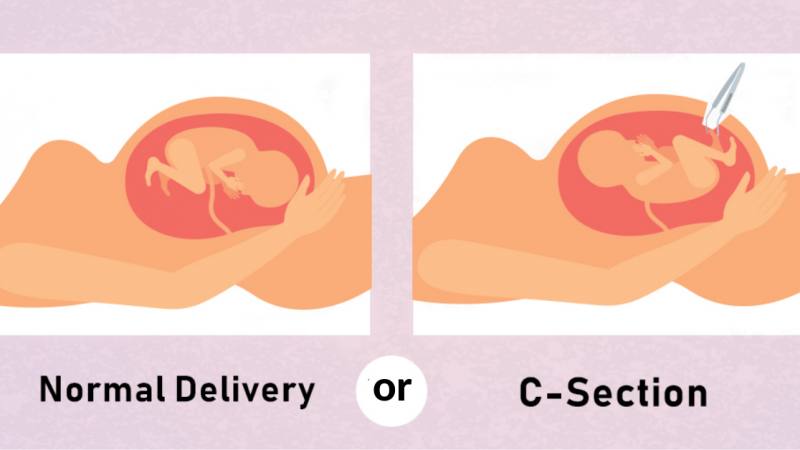 Normal Delivery or Cesarean Delivery