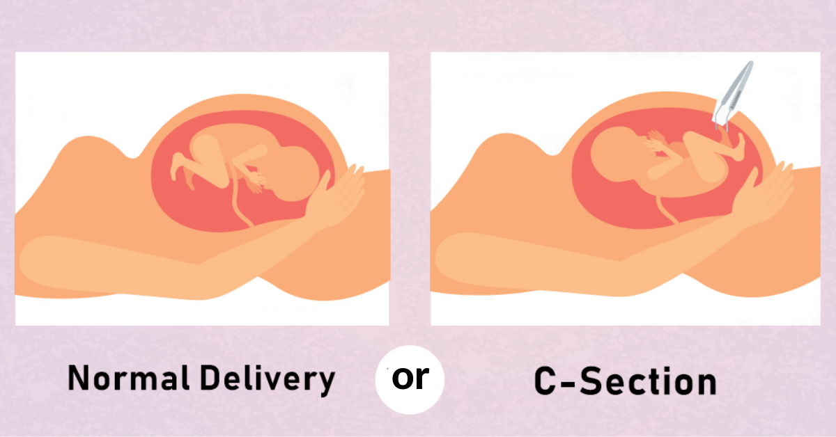 Which delivery is better: Normal Delivery or Cesarean (C-Section