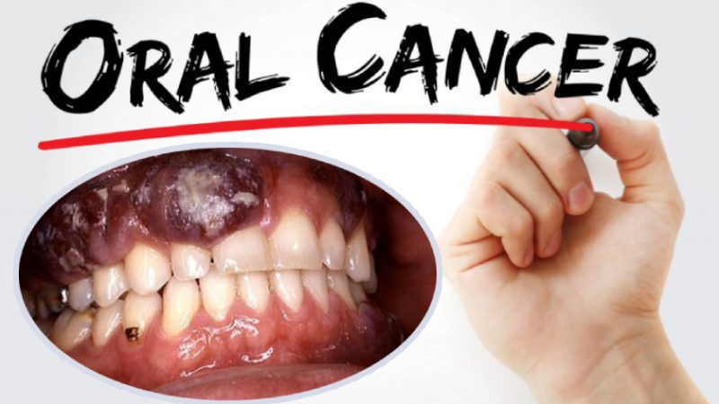 Best Doctors for oral cancer Treatment in Delhi NCR