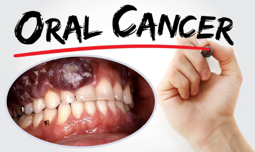 What Are the Types & Treatment for Oral Cancer - Yashoda Hospital
