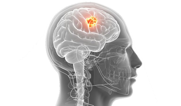 best doctors or neurosurgeons for brain tumors in Ghaziabad
