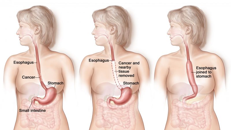 Esophagectomy