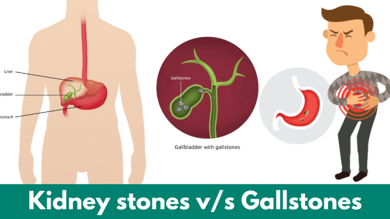 Kidney stones v/s Gallstones