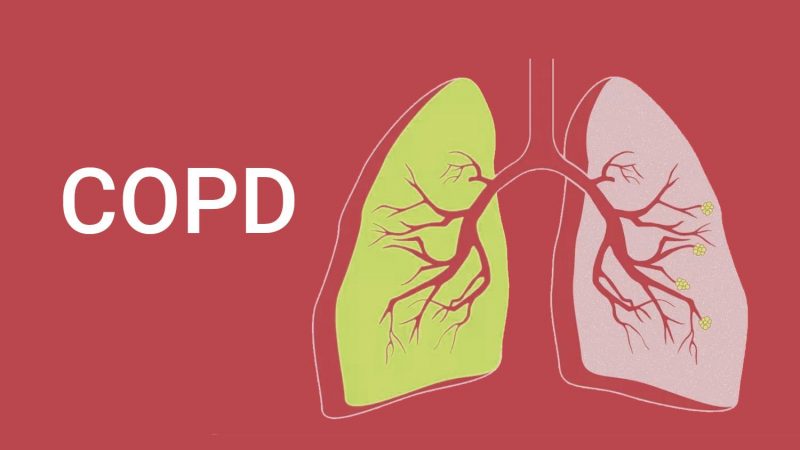 COPD Treatment in Ghaziabad