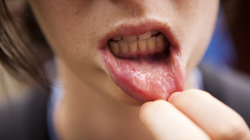 Signs and symptoms of mouth cancer