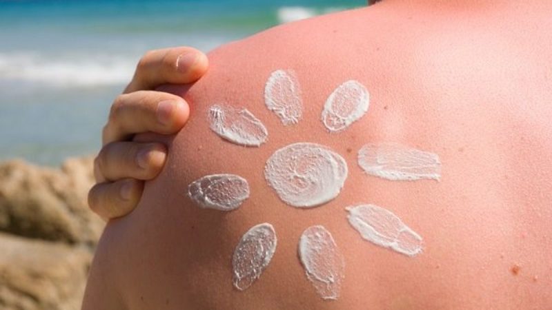 Signs and symptoms of sunburn