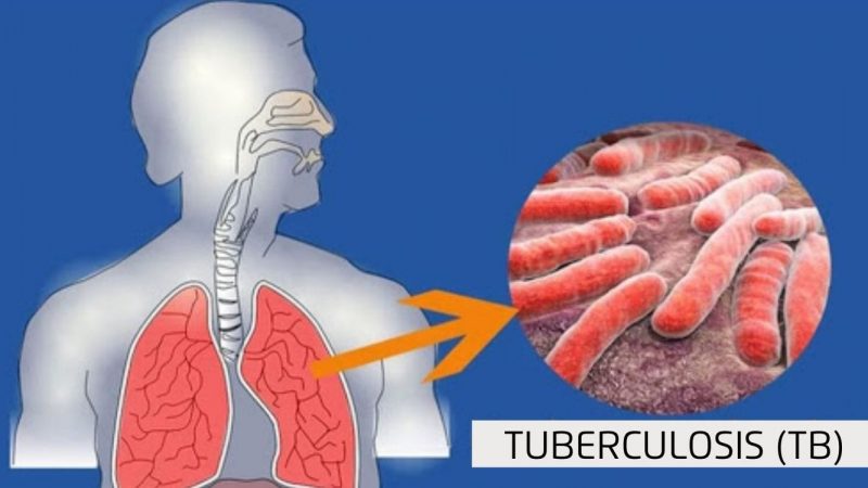 Best Hospital & Doctor For Tuberculosis (TB) Treatment in Ghaziabad & Delhi NCR