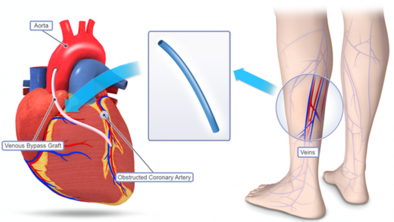 Best Hospital or Doctor For Bypass surgery in Ghaziabad