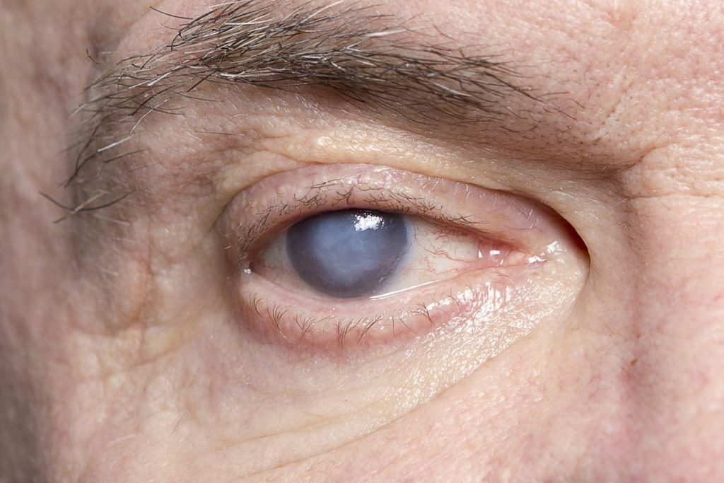 Cataracts (Motiyabind) Symptoms, Treatments and Everything