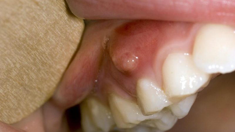 Abscessed Tooth