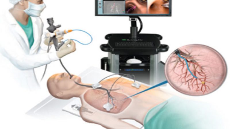 Bronchoscopy Procedure