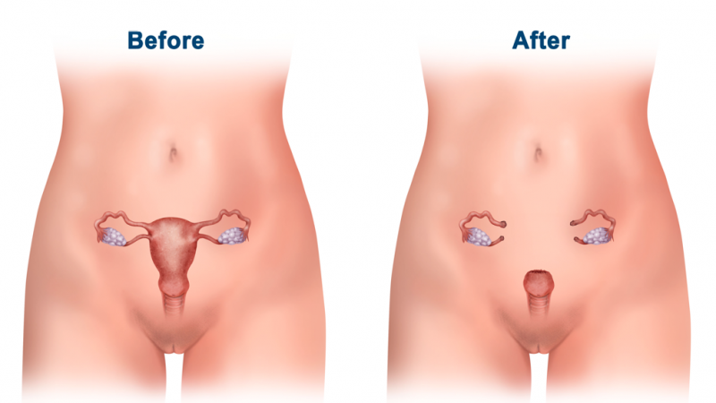 Understand Every Detail About Hysterectomy
