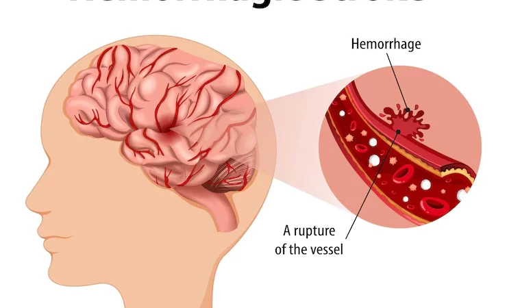 Brain Haemorrhage: How to Detect & the Treatment Involved?