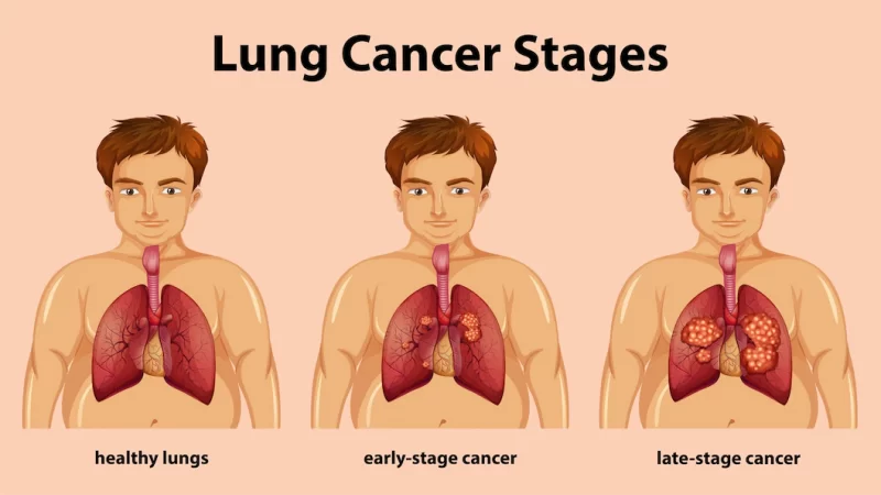 Lung Cancer