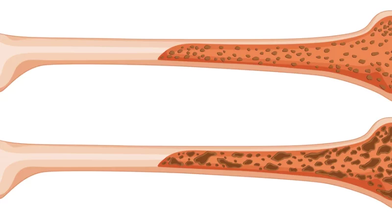 Bone Marrow Transplantation