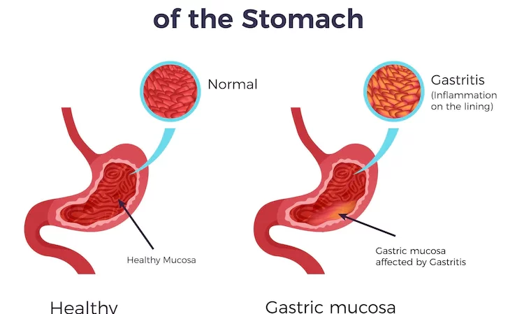 Gastritis