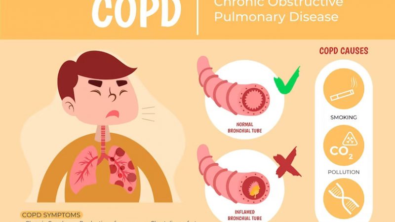 Chronic Obstructive Pulmonary Disease