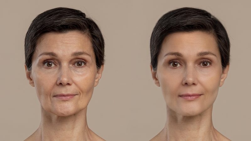 Facial Contouring
