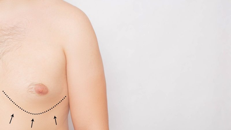 Gynecomastia or Breast Enlargement in Men