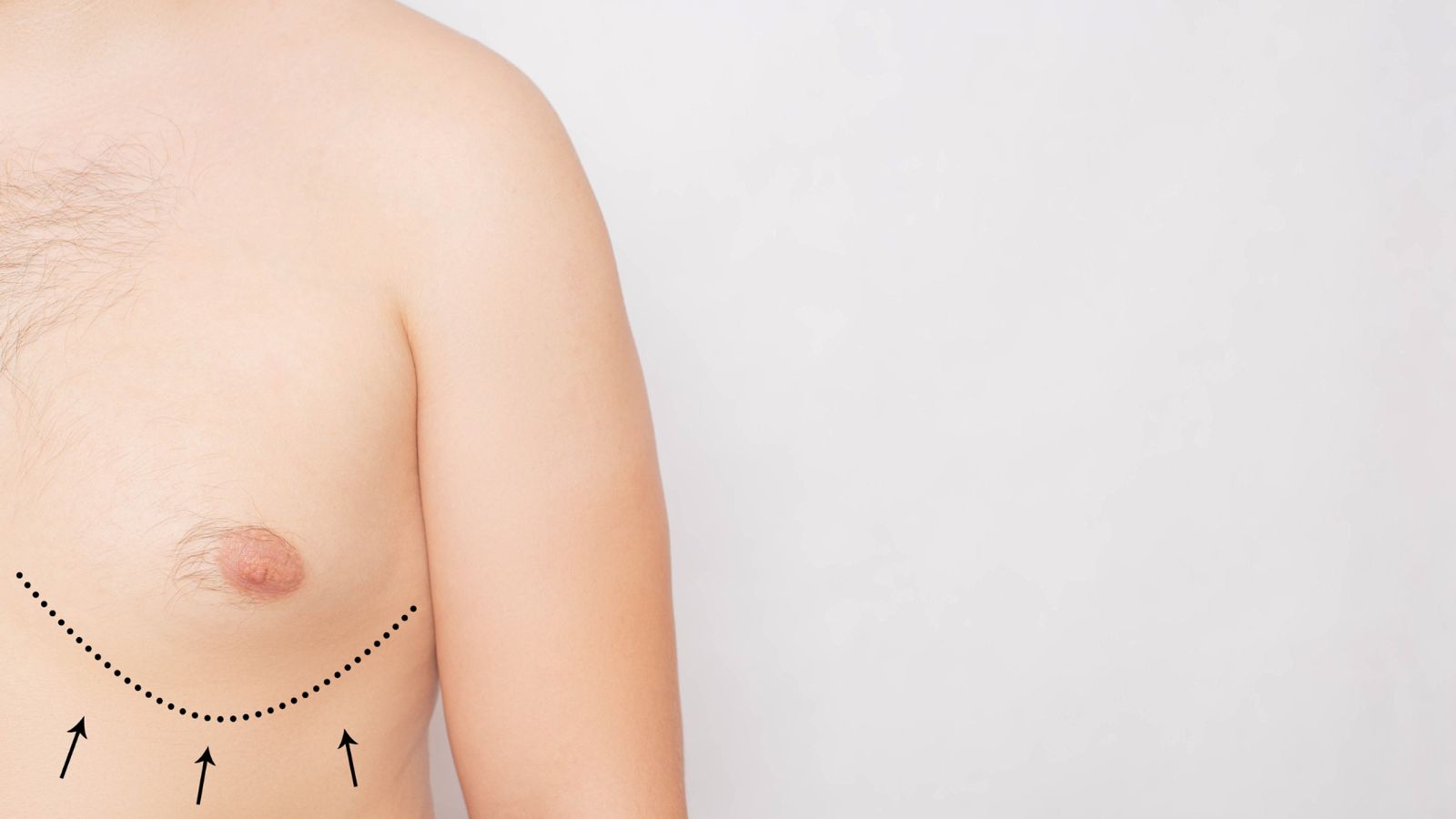 Gynecomastia or Breast Enlargement in Men