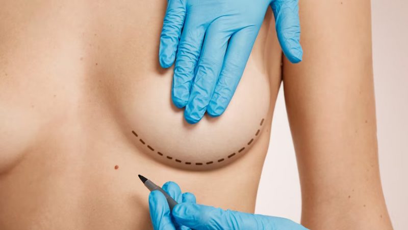 Breast Reduction Surgery