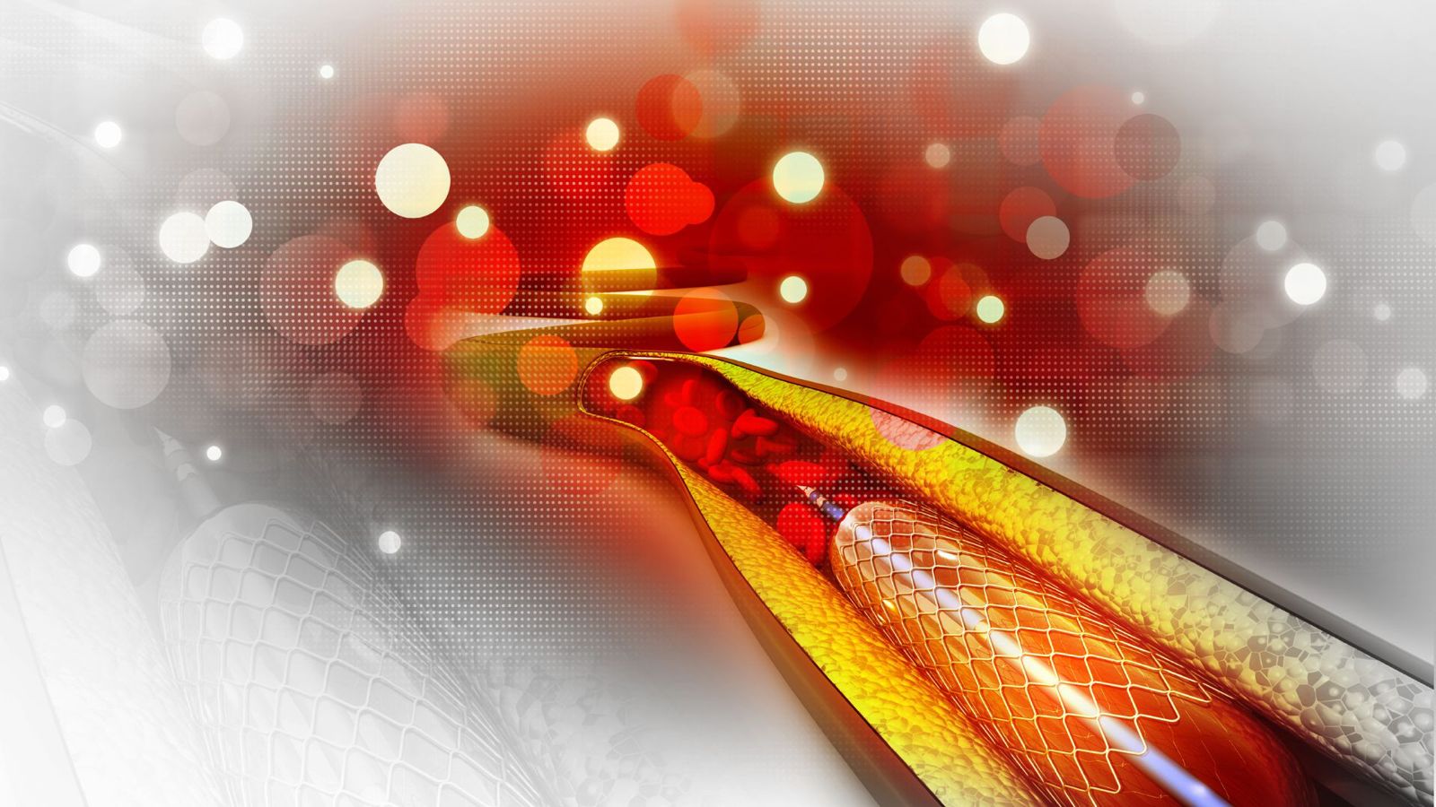 Angioplasty VS Coronary Artery Bypass Grafting (CABG)