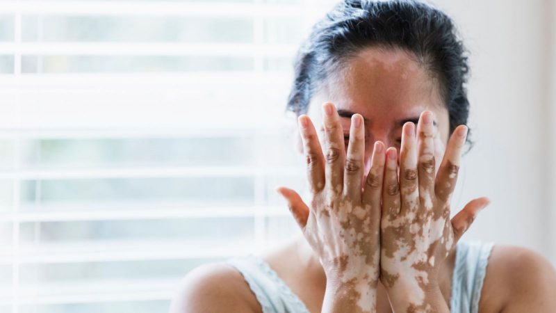 Vitiligo: Types, Symptoms, Causes, Treatment & Recovery