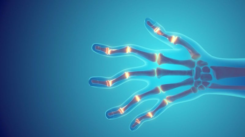 All About Rheumatoid Arthritis