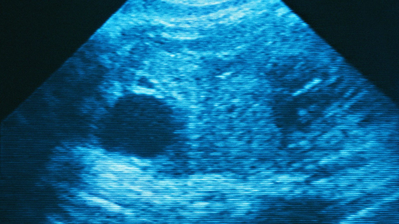 Fetal Anomaly Scan | Pregnancy Scan