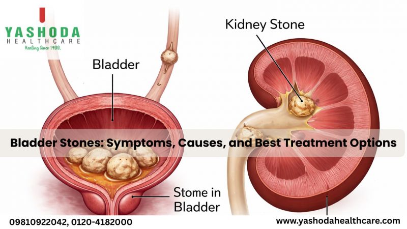 Bladder Stones: Symptoms, Causes, and Best Treatment Options