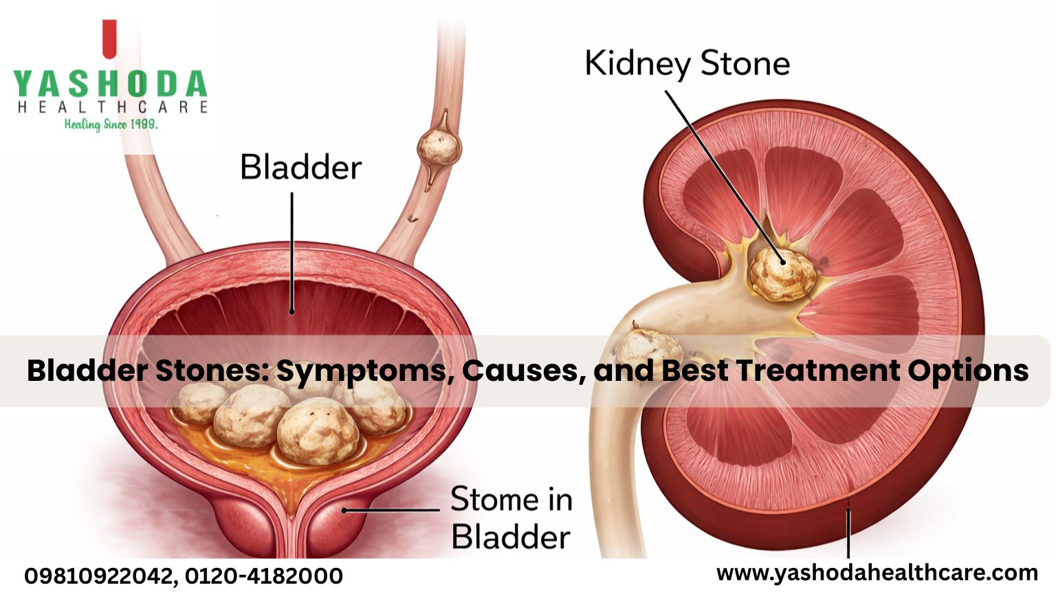 Bladder Stones: Symptoms, Causes, and Best Treatment Options