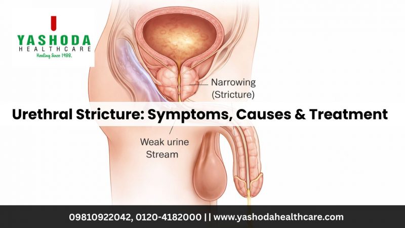 Urethral Stricture Symptoms, Causes & Treatment
