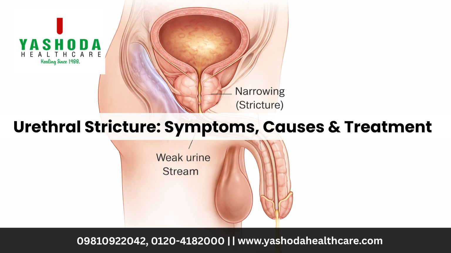 Urethral Stricture: Symptoms, Causes & Treatment