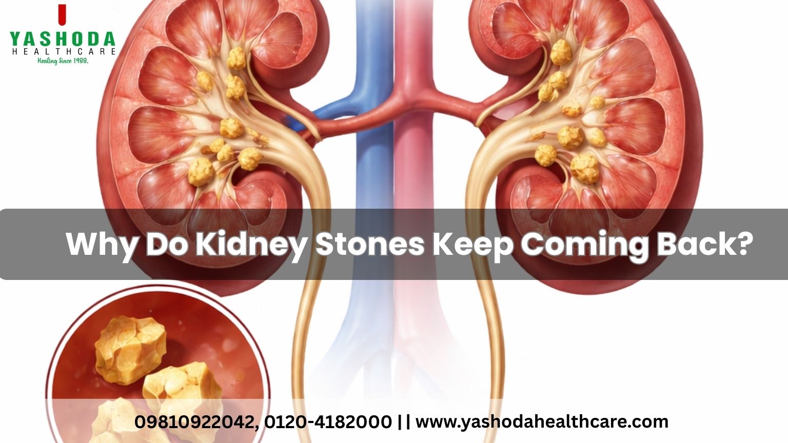 Why Do Kidney Stones Keep Coming Back?